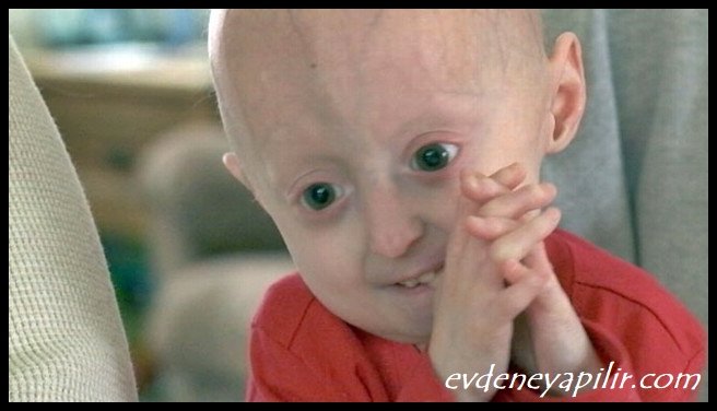 progeria-hastaligi-sendromu-nedir-neden-olur