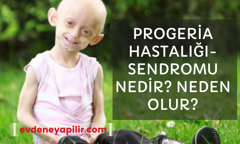 Progeria Hastalığı Sendromu Nedir? Neden Olur?